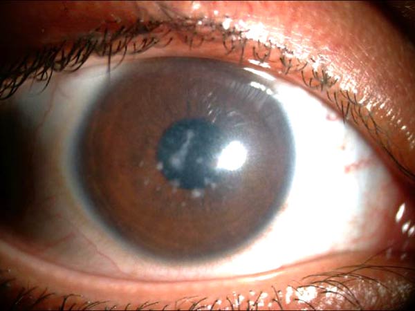 distrophia retina