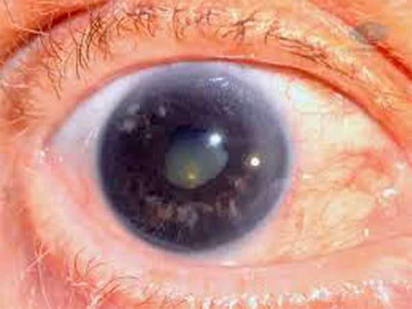 Глаукома Глаз Фото