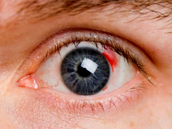 Диабетическая ретинопатия: постепенная и незаметная утрата зрения