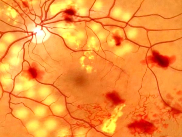 Как остановить потерю зрения при диабетической ретинопатии