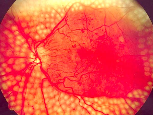 Как остановить потерю зрения при диабетической ретинопатии