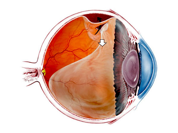 Отслоение сетчатки – одна из самых серьезных проблем зрения
