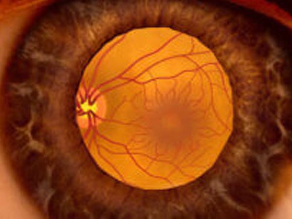 retinal disinsertion
