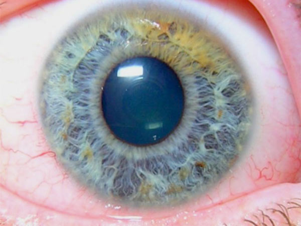 Глаукома – көрүүнү тымызын өлтүрүүчү